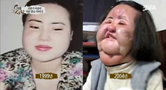 由于“整容中毒”甚至到了精神分裂程度的“风扇大妈”,对整容的依赖已经到了失去理智的地步,甚至自行往脸上注射食物油,其疯狂整容行为实在令人震惊。
